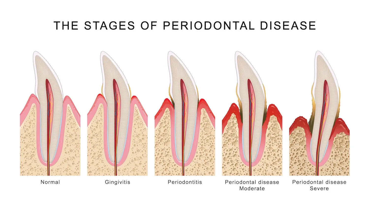 Pathologie parodontale S3 