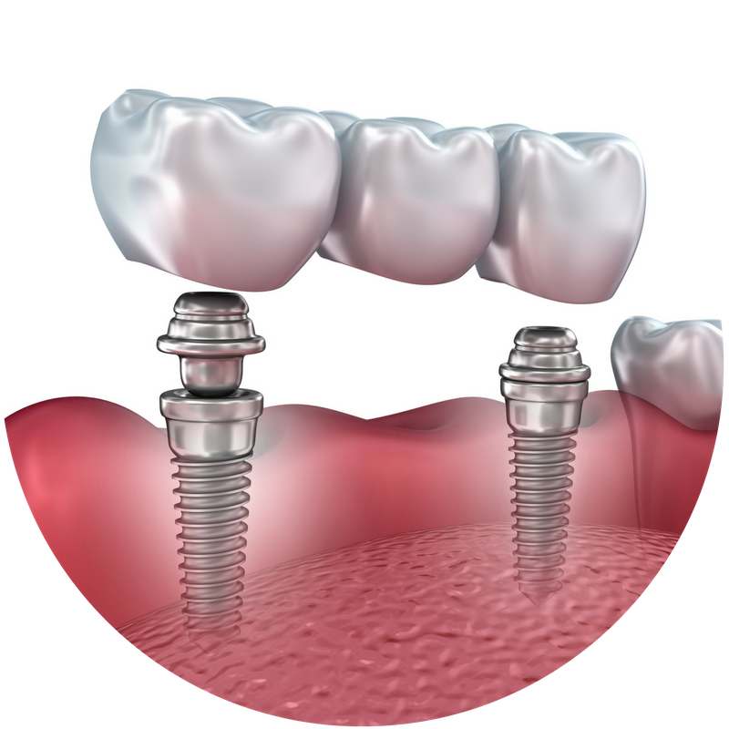 Prothèse conjointe plurale