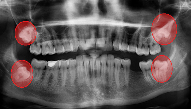 Pathologie de la dentition