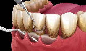 Thérapeutiques parodontales 